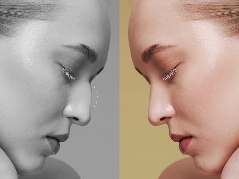 dogal-burun-estetigi-ne-degildir