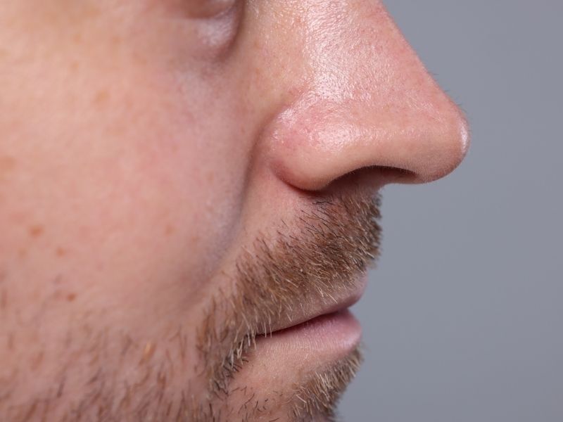 maskulen-erkek-burun-estetigi