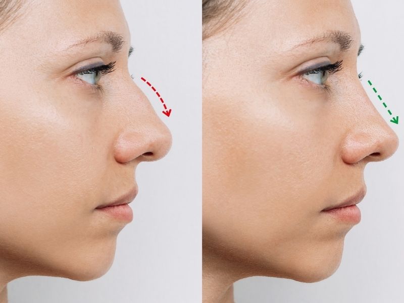 rinoplastinin-amaci-nedir