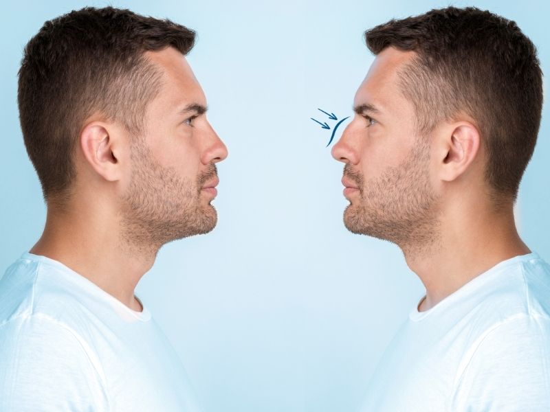 ileri-revizyon-rinoplasti-neyi-farkli-kilar