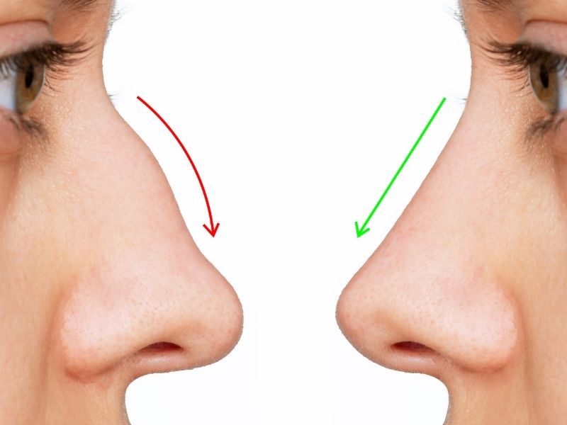 kikirdak-greft-nedir-burun