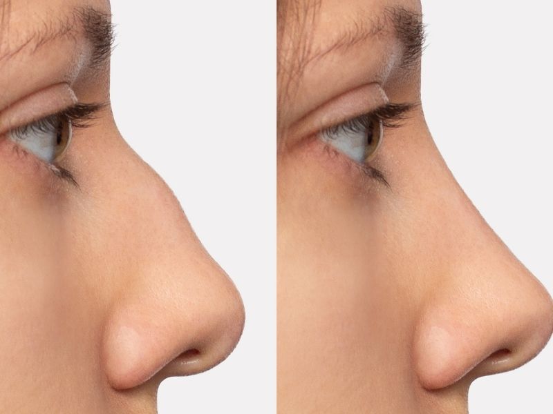 kikirdak-grefti-kullanimi-rinoplasti-sonucunu-nasil-etkiler