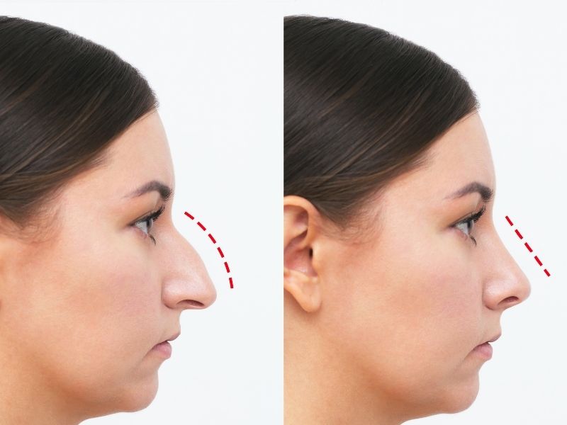 kikirdak-grefti-nedir