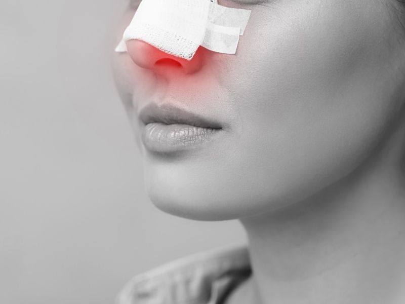 rinoplastinin-ertelenmesi-gereken-durumlar